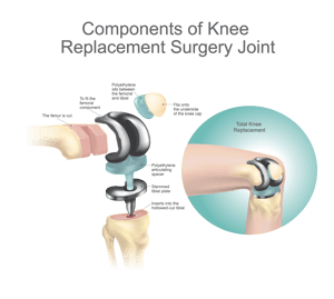 Knee Replacement Components